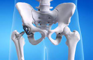 Pelvic joint replacement in Iran